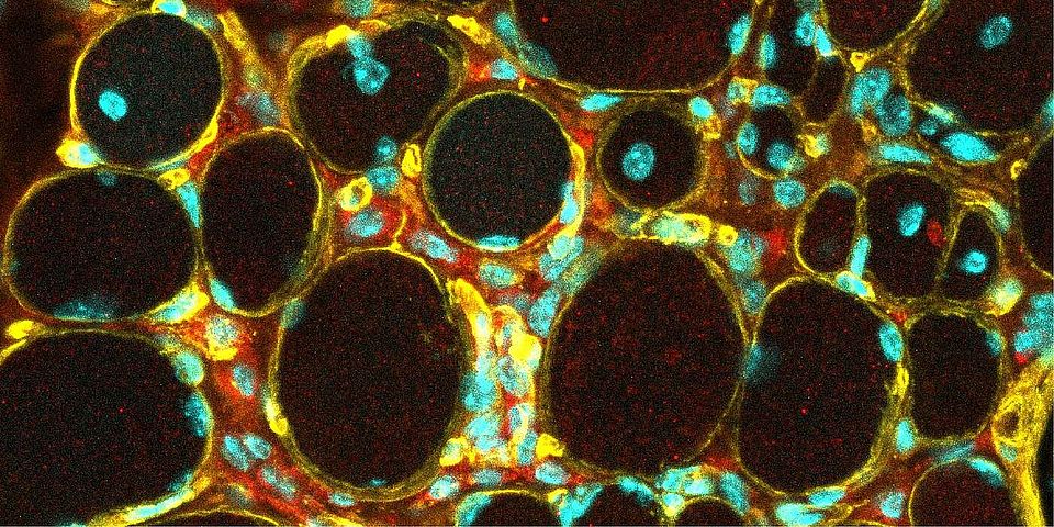 weakened extracellular matrix (yellow) leads to muscle fiber degeneration and the infiltration of immune cells (red) into the tissue